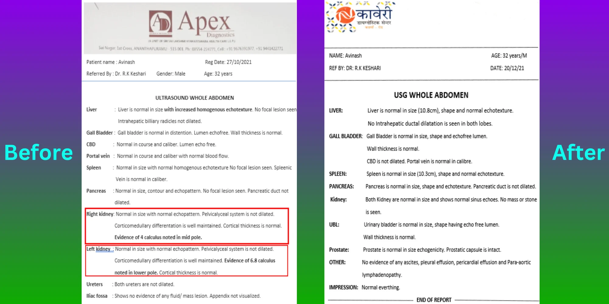 Gallstone Patient Avinash - Before After Treatment