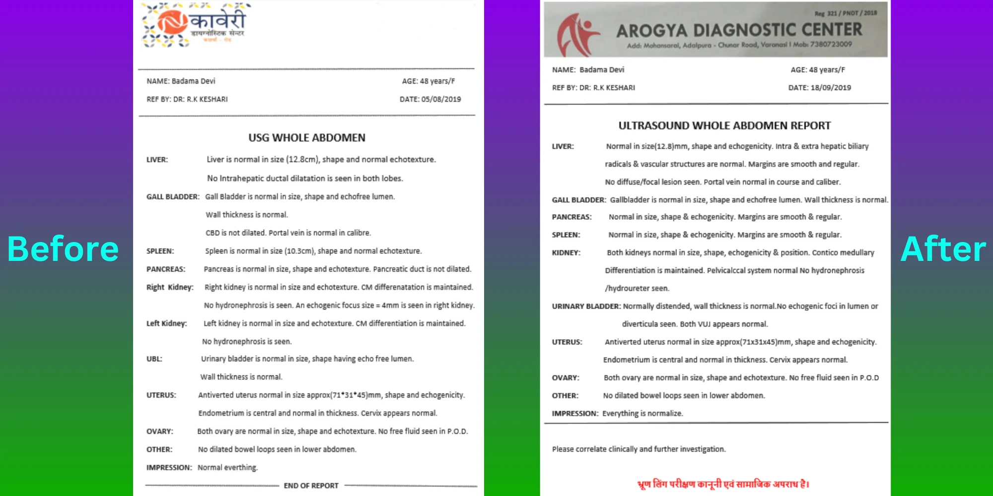 Gallstone Patient Badama Devi - Before After Treatment