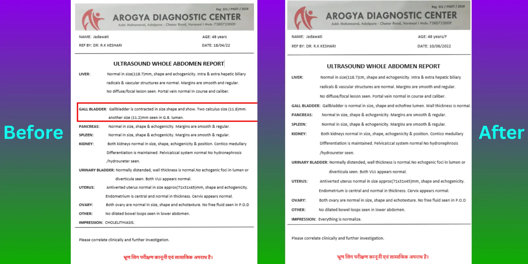 Gallstone Patient Jadawati - Before After Treatment