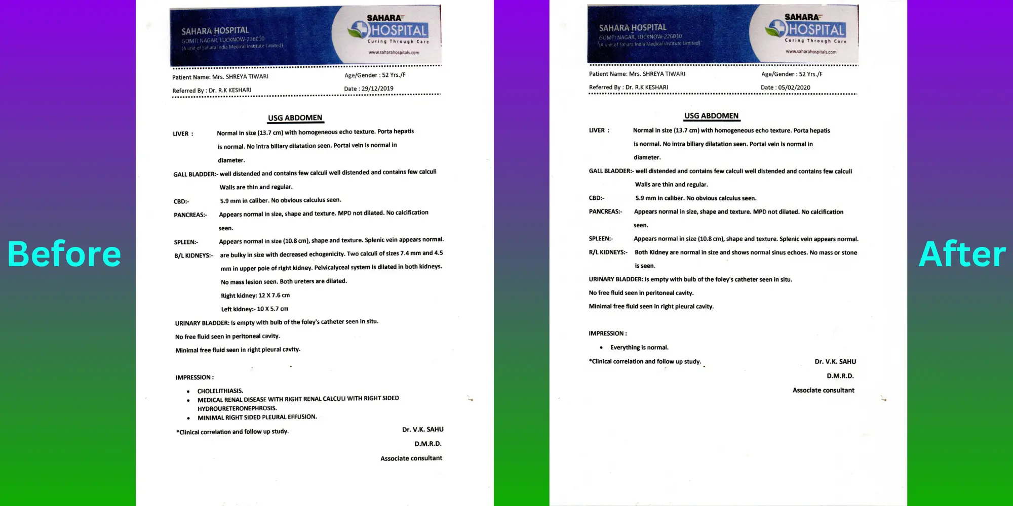 Gallstone Patient Shreya - Before After Treatment