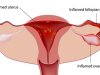 कष्टार्तव (दर्दयुक्त महामारी ) Dysmenorrhea (painful menorrhagia)
