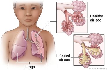 Pneumonia (निमोनिया)