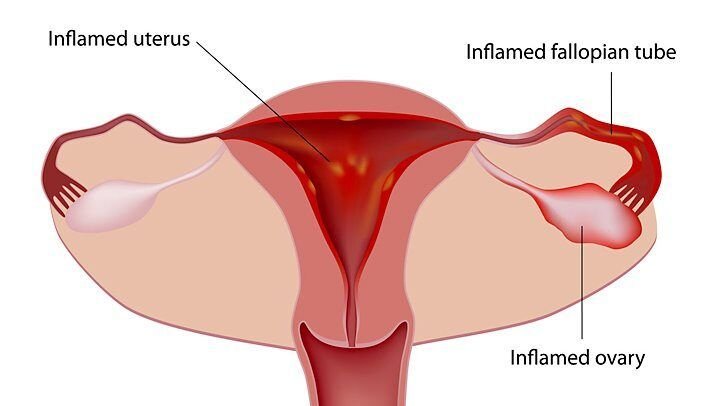 कष्टार्तव (दर्दयुक्त महामारी ) Dysmenorrhea (painful menorrhagia)