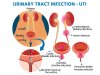 मूत्र मार्ग में संक्रमण के लिए आयुर्वेद, कारण, लक्षण और उपचार