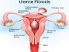 गर्भाशय फाइब्रॉएड