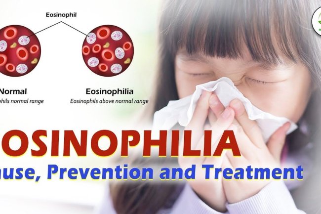 Eosinophilia