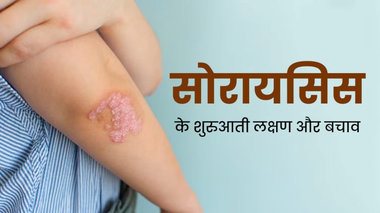 सोरायसिस के कारण, लक्षण और उपचार | Psoriasis In Hindi